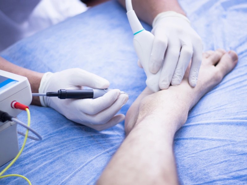 Neuromodulación percutánea: su aplicación en&nbsp;fisioterapia